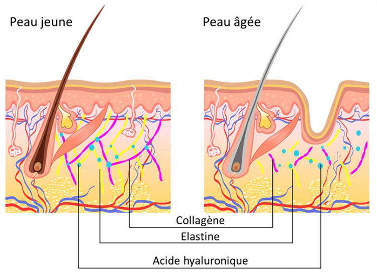 Avec l'âge, la structure de la peau est altérée et la quantité de collgène diminue.