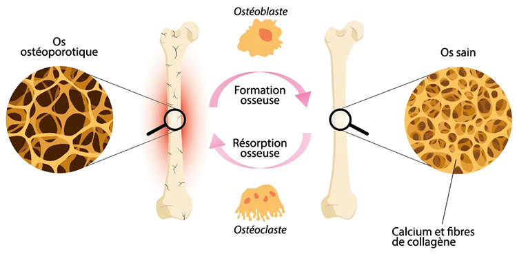 Ostéoporose et diminution de la densité osseuse